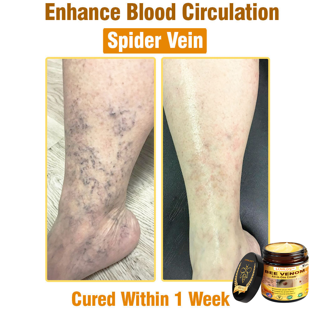 𝐋𝐎𝐕𝐈𝐋𝐃𝐒™ 𝐁𝐞𝐞 𝐕𝐞𝐧𝐨𝐦 𝐀𝐥𝐥-𝐢𝐧-𝐎𝐧𝐞 𝐂𝐫𝐞𝐚𝐦–🌸 Anti-aging,Hydrating, Skin Repair, Even Tone, Acne and Dark Spot Treatment, Wart and Mole Removal, Psoriasis Relief